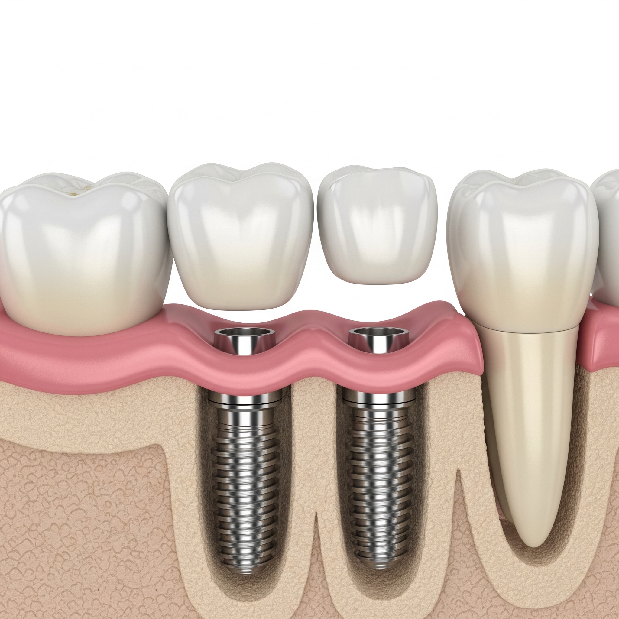 Illustration 3D anatomique montrant deux implants vissés dans l'os de la mâchoire, avec les couronnes en attente de pose sur les piliers.