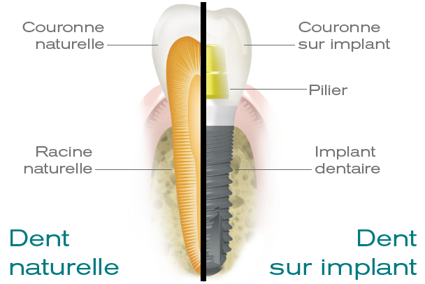 illustration d'une coupe d'un implant dentaire et d'une dent naturelle
